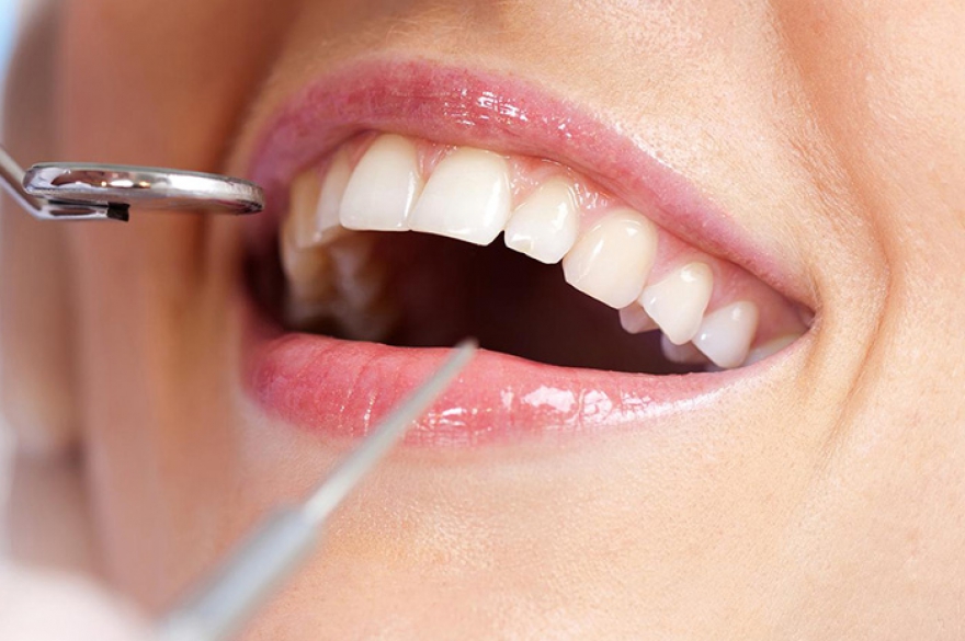 Как работает домашнее отбеливание? Максимум 3 тона по шкале Vita, 1 месяц Татьяна Морева, стоматолог-терапевт, заместитель главного врача клиники