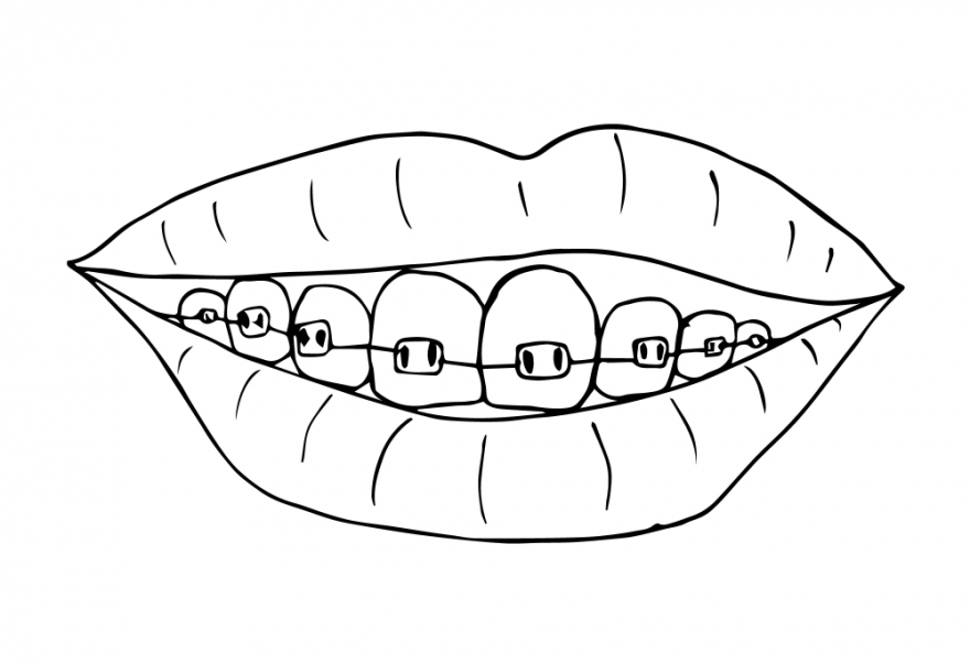 Последствия брекетов: то, о чем вас никто не предупреждал