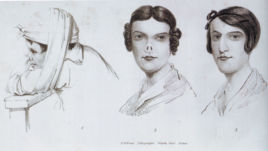 Картинка из книги по пластической хирургии, выпущенной в 1840 году, иллюстрирует операцию, проведенную в 1830-е годы