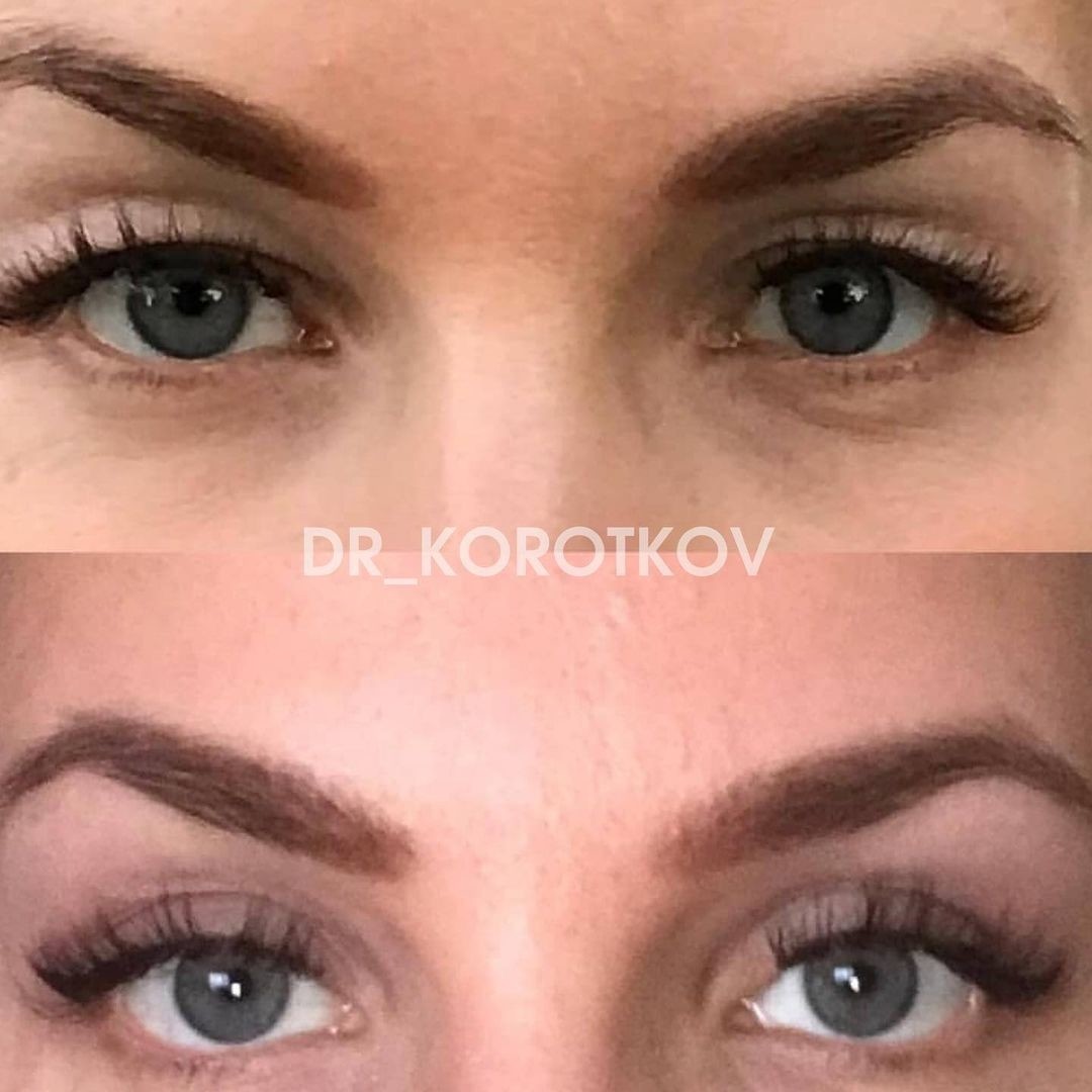 Результат до и после процедуры блефаропластики