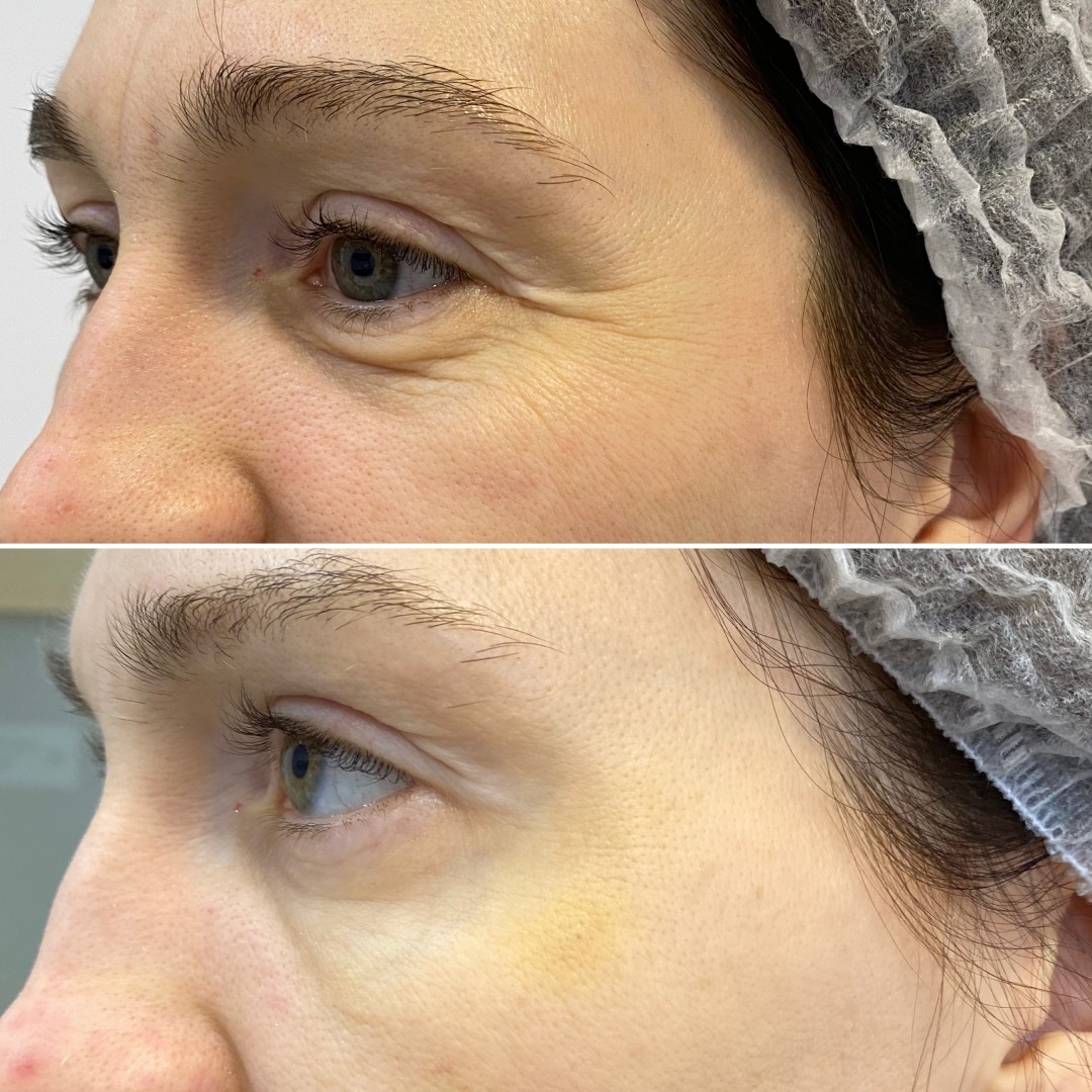 Результат до и после процедуры нитевого лифтинга глаз