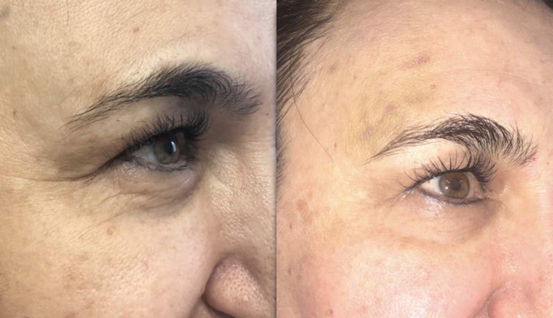 Результат до и после процедуры нитевого лифтинга глаз