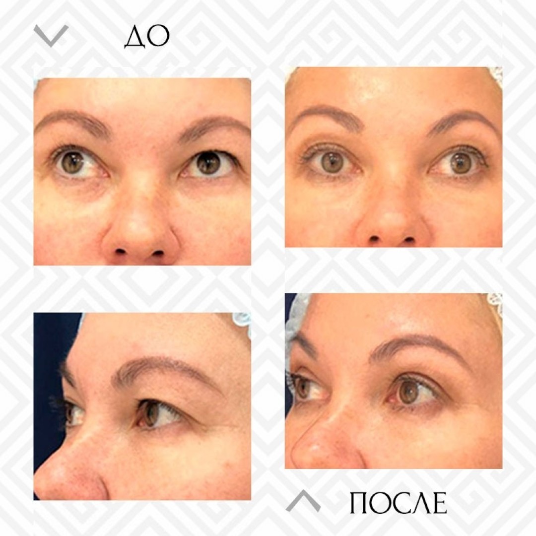 Результат до и после процедуры Ulthera