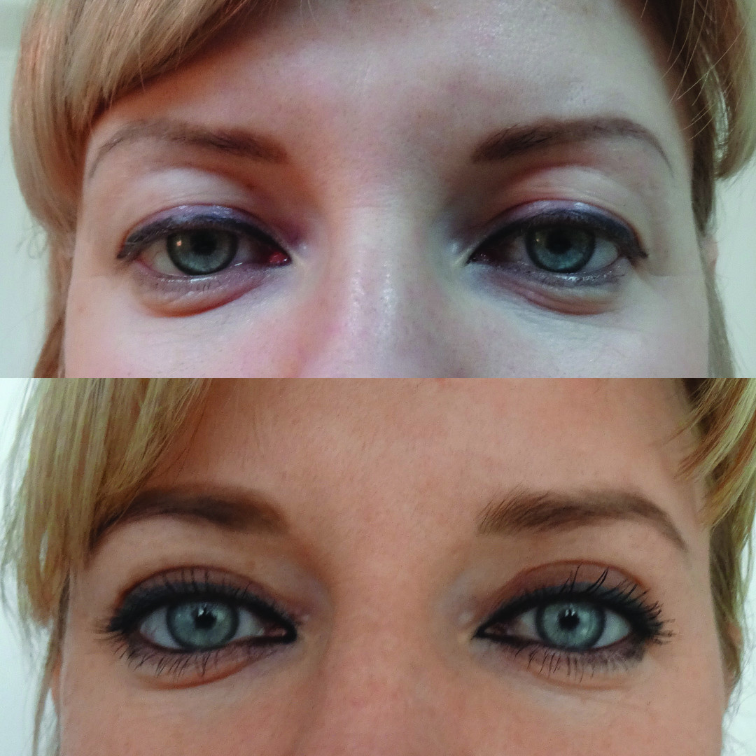 Результат до и после процедуры блефаропластики