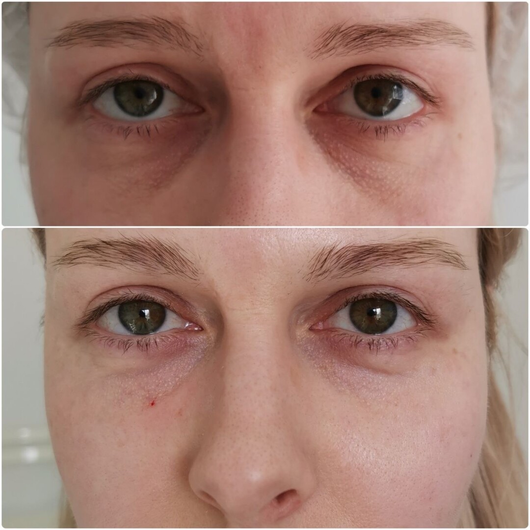 До и после устранения темных кругов и западения под глазами препаратом Belotero balance