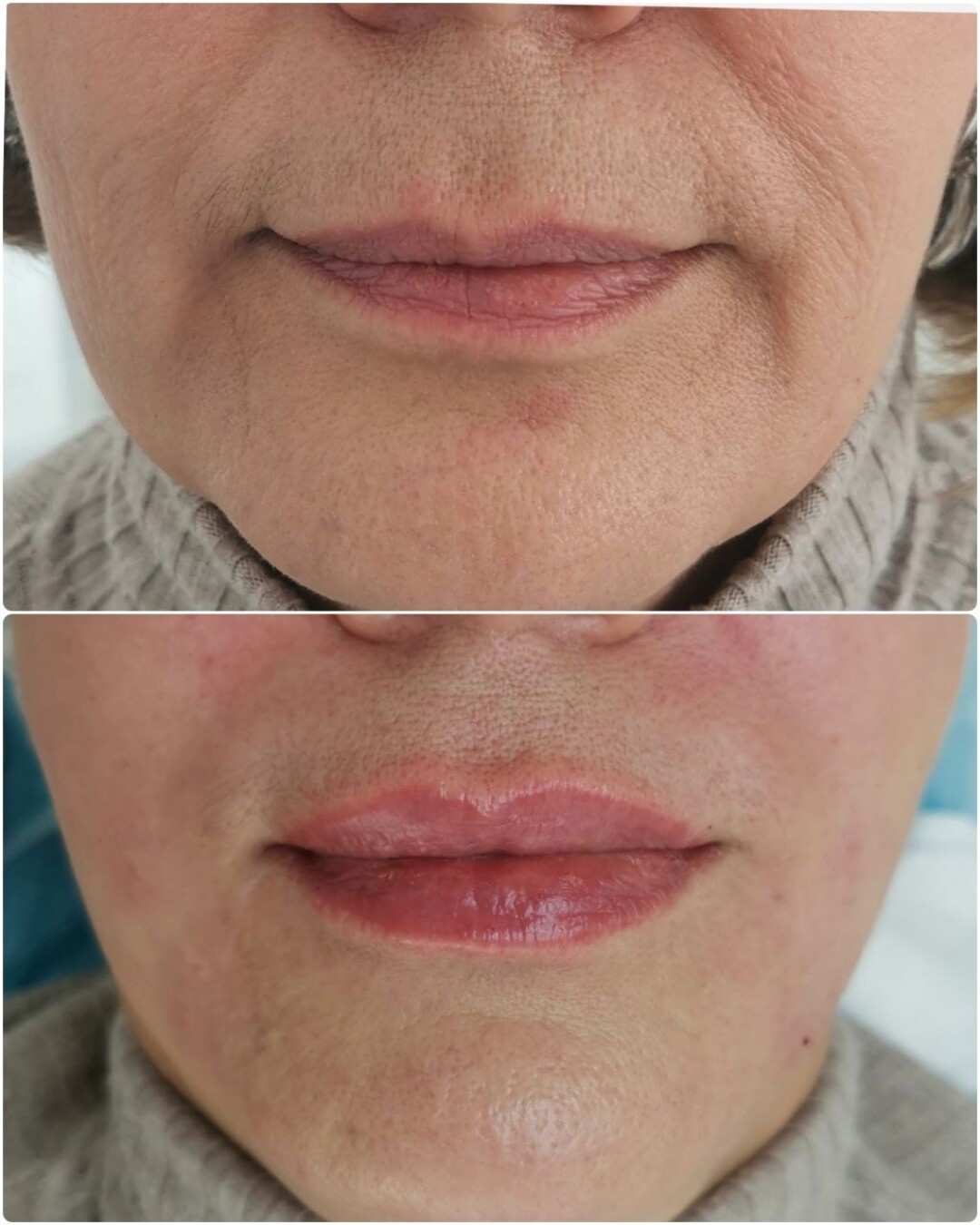 До и после омоложения нижней трети лица Radiesse и Belotero в канюльной технике