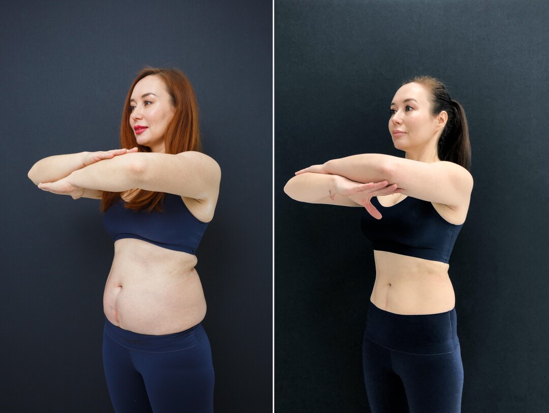 До и после процедуры криолипосакции