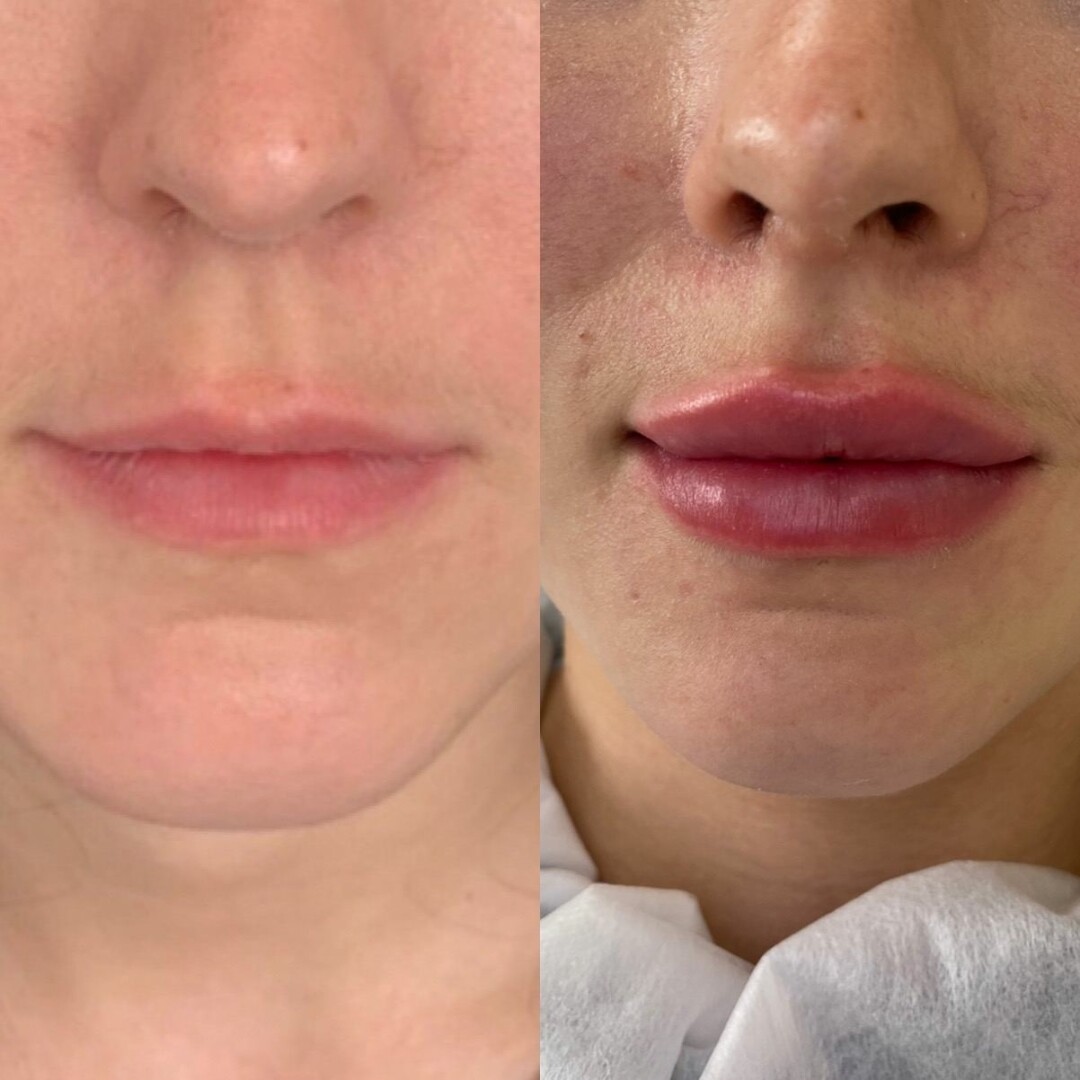 До и после коррекции губ препаратом Image
