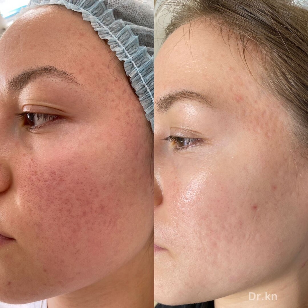 До и после лечения акне лазером