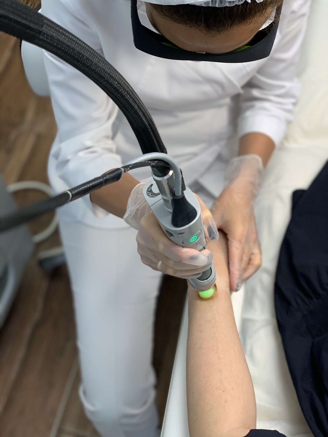 Лазерная эпиляция