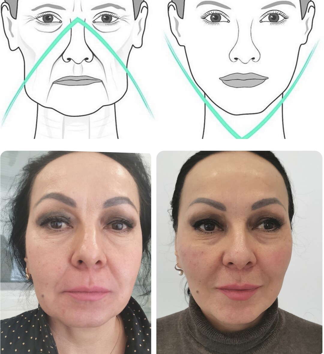 Комплексная работа: липолитики, филлеры, Ксеомин, векторный лифтинг