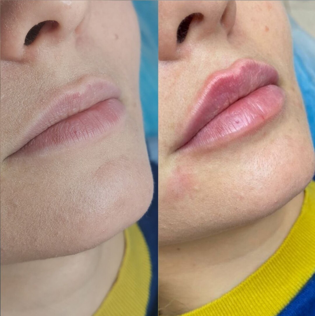 До и после процедуры Lips for kiss