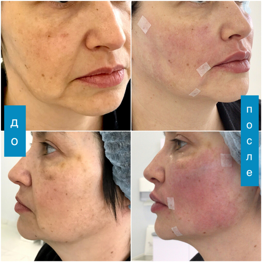 До и после процедуры «Бьютификация за час», работа филлерами Radiess, Belotero, векторный лифтинг, канюльная техника
