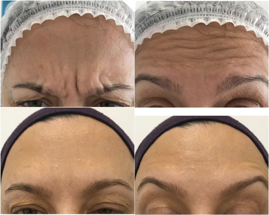 До и после устранения мимических морщин (Ксеомин/Ботокс/Диспорт). Результат при попытке нахмуриться и сморщить лоб